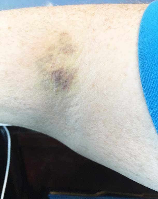 Right arm after botched platelet donation